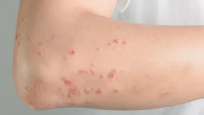 اخبار اليمن الان أخصائية أعراض حساسية الطعام مقدمات اخبار اليمن الان الحدث اليوم عاجل