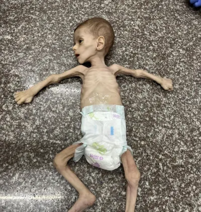 اخبار اليمن الان طفلين فلسطينيين وجنوب التغذية والمجاعة اخبار اليمن الان الحدث اليوم عاجل