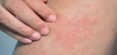 اخبار اليمن الان وزارة الصحة للوقاية الجلدي الحراري اخبار اليمن الان الحدث اليوم عاجل