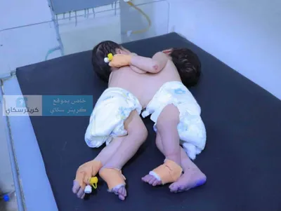 اخبار اليمن الان سباق لإنقاذ توأم سيامي الولادة اخبار اليمن الان الحدث اليوم عاجل