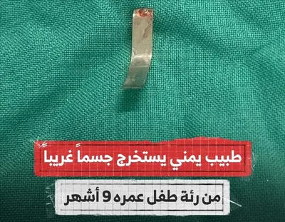 اخبار اليمن الان طبيب يمني ينقذ رضيع استخراج اخبار اليمن الان الحدث اليوم عاجل