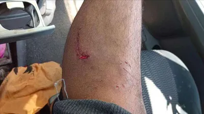 اخبار اليمن الان كلب مسعور يعض مواطنين عدن اخبار اليمن الان الحدث اليوم عاجل