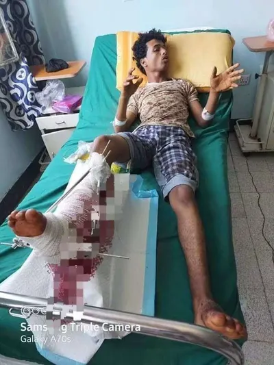 اخبار اليمن الان الاعرج معاناته والإهمال والعلاج بالوساطة اخبار اليمن الان الحدث اليوم عاجل