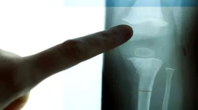 اخبار اليمن الان نخاع العظم عملية شيخوخة الجسم اخبار اليمن الان الحدث اليوم عاجل