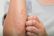 عاجل السعودية اخبار اليمن الان النظافة متوقع لظهور تقيحات الجلد اخبار اليمن الان الحدث اليوم عاجل عاجل السعودية