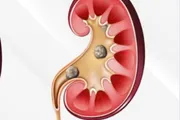 عاجل السعودية اخبار اليمن الان استشاري أسباب لتكون حصوات الكلى اخبار اليمن الان الحدث اليوم عاجل عاجل السعودية
