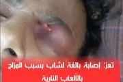 كريتر إسكاي اخبار اليمن الان إصابة خطيرة المزاح بالألعاب النارية اخبار اليمن الان الحدث اليوم عاجل كريتر إسكاي