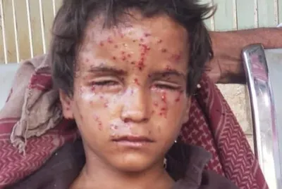 اخبار اليمن الان الجوف بانفجار مخلفات الحوثي المتون اخبار اليمن الان الحدث اليوم عاجل