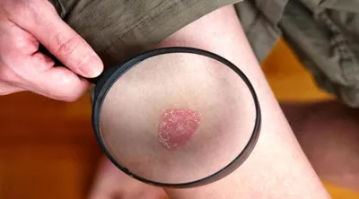 اخبار اليمن الان دراسة طريقة فعالة لتقليل الصدفية اخبار اليمن الان الحدث اليوم عاجل