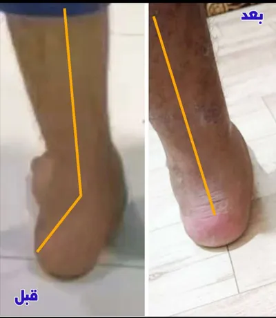 اخبار اليمن الان باستخدام تقنية حديثة تصحيح المعاناة اخبار اليمن الان الحدث اليوم عاجل