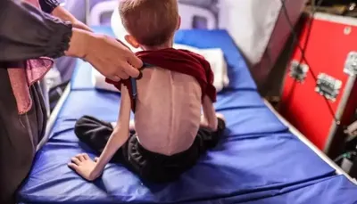 اخبار اليمن الان الصحة العالمية ارتفاع معدلات التغذية اخبار اليمن الان الحدث اليوم عاجل