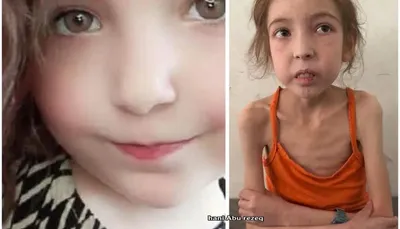 اخبار اليمن الان الطفولة تكبر مأساة يقتلها الجوع اخبار اليمن الان الحدث اليوم عاجل