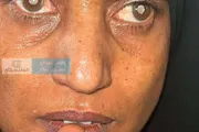 كريتر إسكاي اخبار اليمن الان الظلام الأمل تنتظر استعادة بصرها اخبار اليمن الان الحدث اليوم عاجل كريتر إسكاي